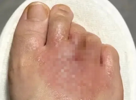 脚上小水疱别乱涂药！1招教你分清湿疹还是脚气
