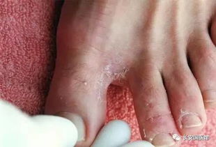 脚上红痒起皮，3步教你分清脚气还是湿疹