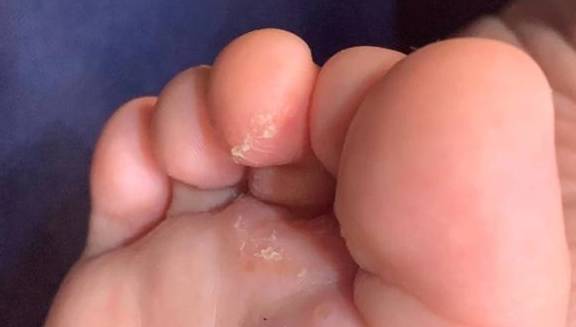 脚上红痒起皮，是脚气还是湿疹？一篇文章教你准确分辨